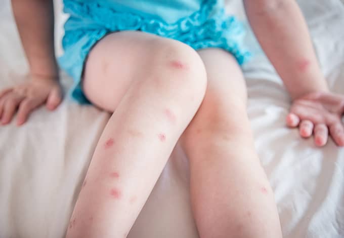 A child's leg full of bed bug bites