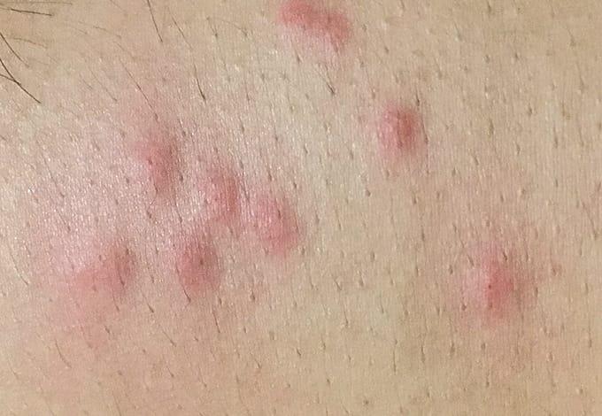 Bed bug bites on skin