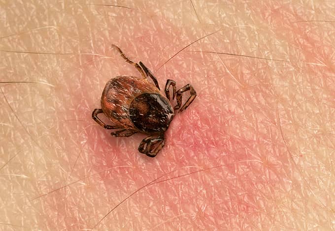 A tick embedded on the skin